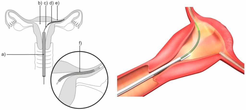 Essure birth control device