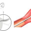 Essure Problems Continue to Mount for Bayer as FDA Report Cites Growing Concern