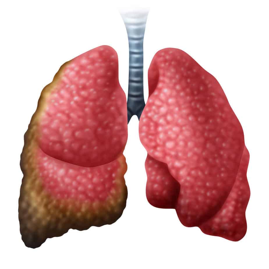 Mesothelioma cancer disease concept as human lungs with growing malignant cancer cells as a medical illness conceptual symbol for asbestos exposure in a 3D illustration style.