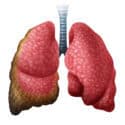 Study Finds Wide Disparity in Global Rates of Mesothelioma