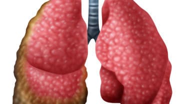 Study Finds Wide Disparity in Global Rates of Mesothelioma