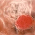 Study Links Proton Pump Inhibitor Use to Esophageal Cancer