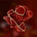 $3.6 Million Award in Bard IVC Filter Case