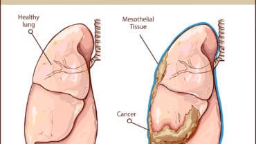 Tumor Treating Fields Shows Promising Results for Mesothelioma