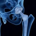 Johnson & Johnson Begins Settlements for Defective Hip Implant Claims