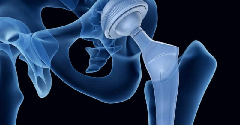 Johnson & Johnson Begins Settlements for Defective Hip Implant Claims