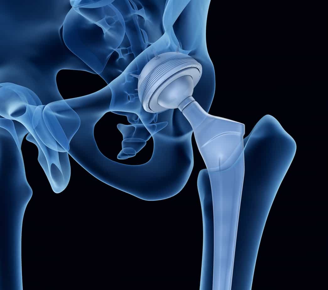 Johnson And Johnson Hip Replacement Lawsuit Johnson & Johnson Begins Settlements for Defective Hip Implant Claims