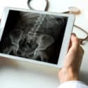 North Carolina Man Sues Zimmer U.S. Inc. for Allegedly Defective Hip System