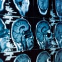 4 Reasons to Consult with a Lawyer After a Brain Injury Accident