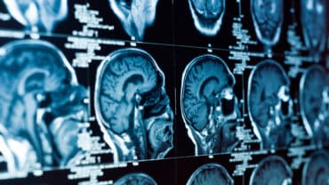 4 Reasons to Consult with a Lawyer After a Brain Injury Accident