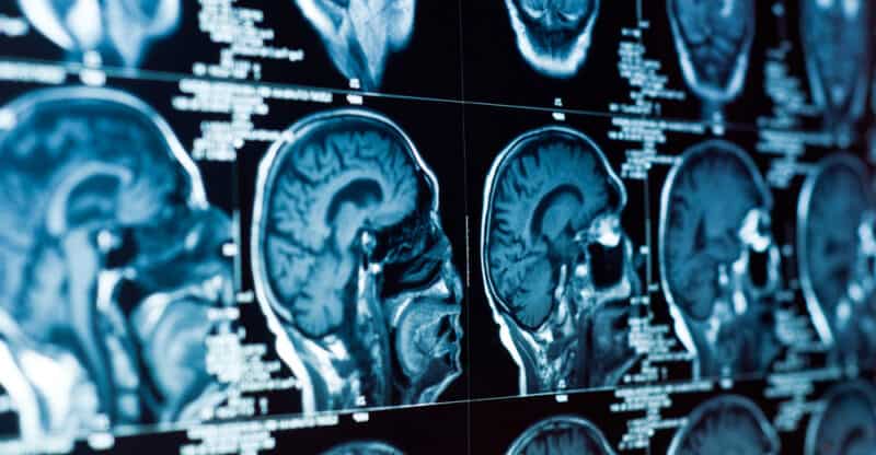 4 Reasons to Consult with a Lawyer After a Brain Injury Accident