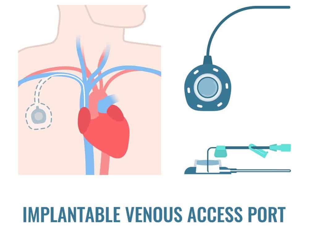 implantable port injuries