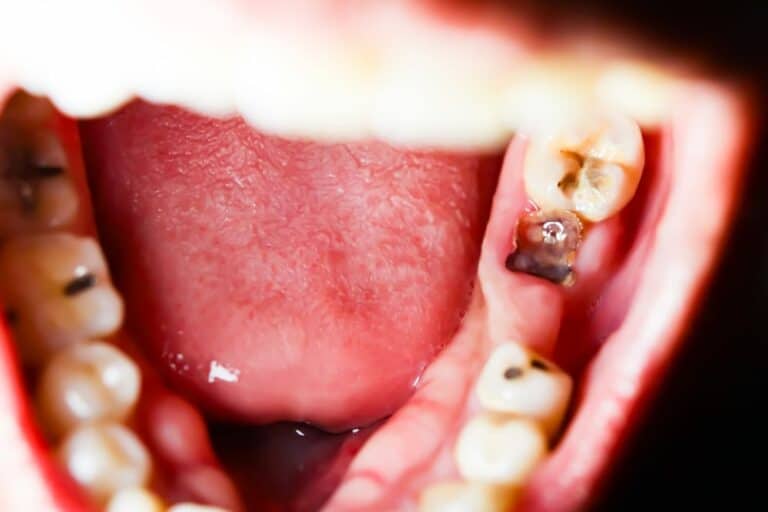 Suboxone Lawsuit Your Legal Right to a Tooth Decay Claim