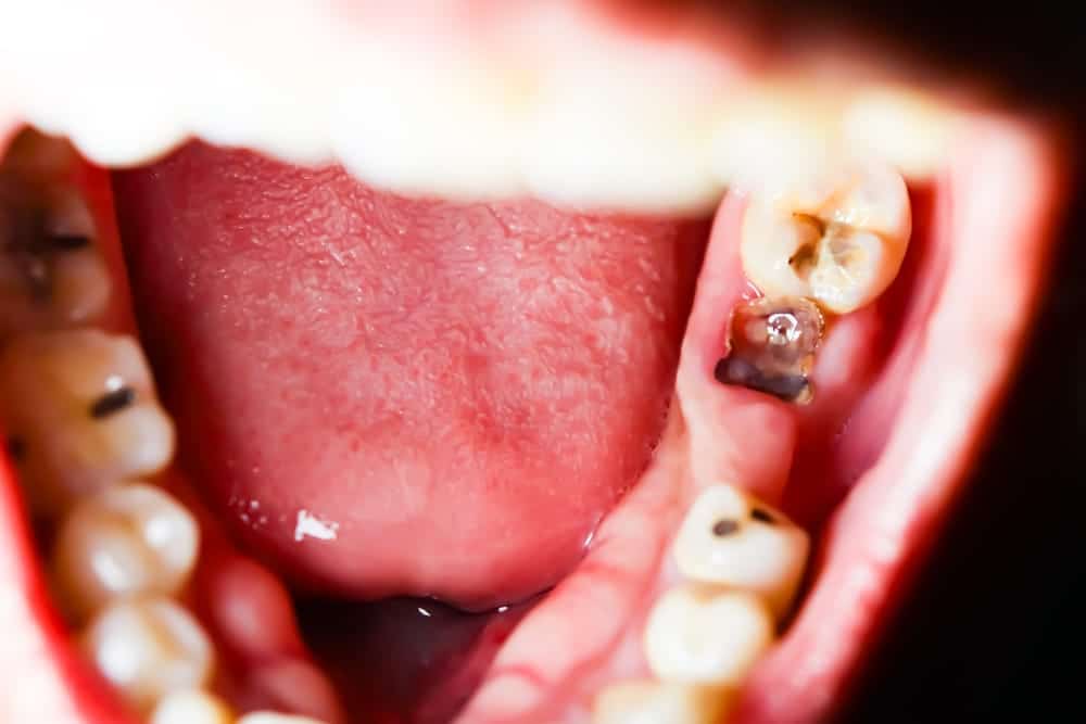 tooth decay and dental issues